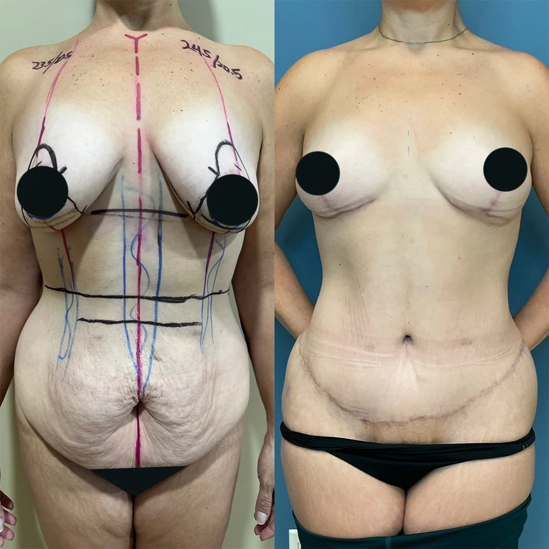 Tummy Tuck + Liposuction + Breast Lift — before and after result by Dr. Jonathan Zaga