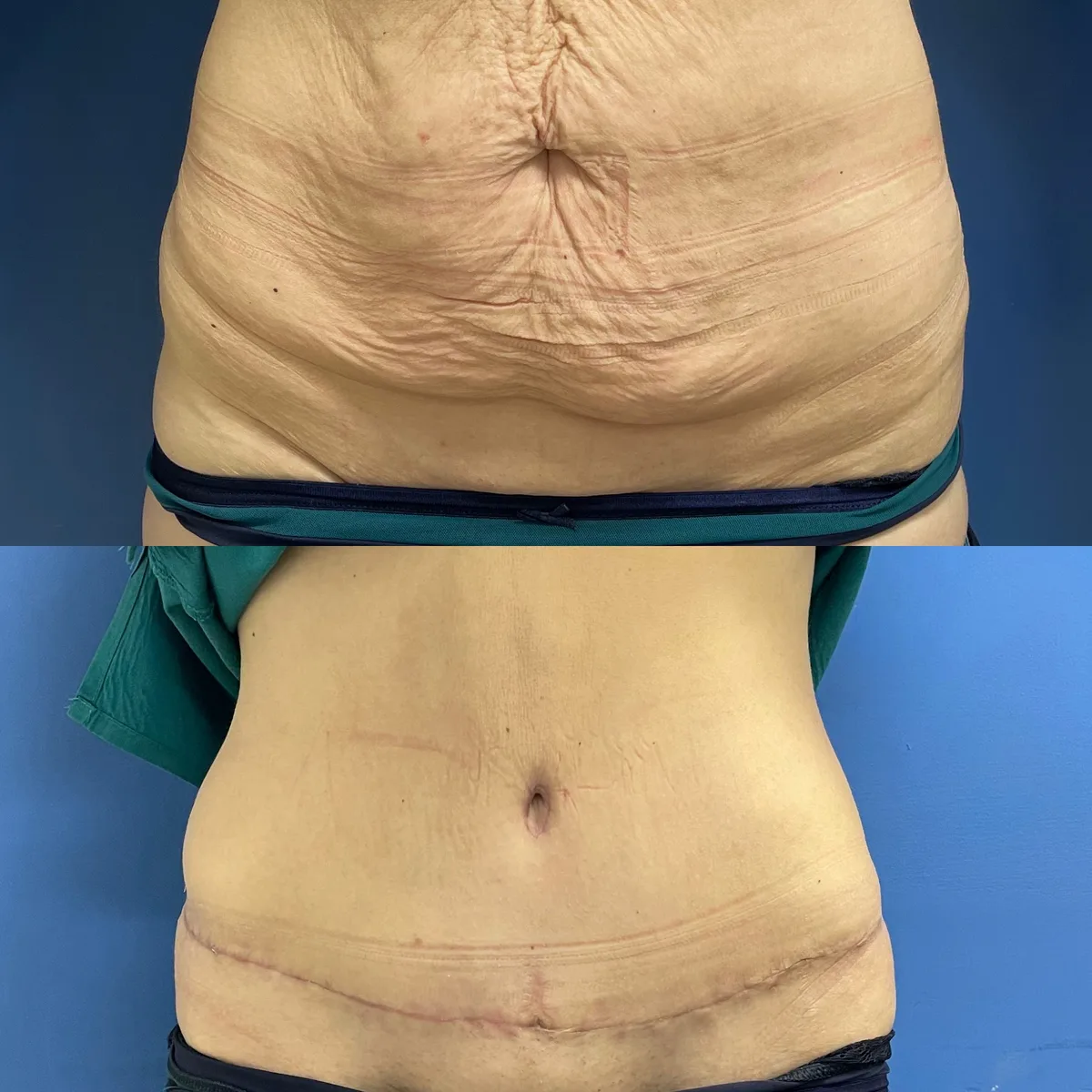 Tummy Tuck (Abdominoplasty) — before and after result by Dr. Jonathan Zaga