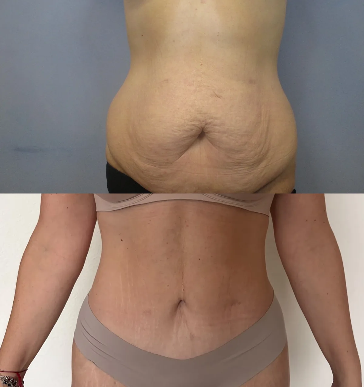 Tummy Tuck (Abdominoplasty) — before and after result by Dr. Jonathan Zaga