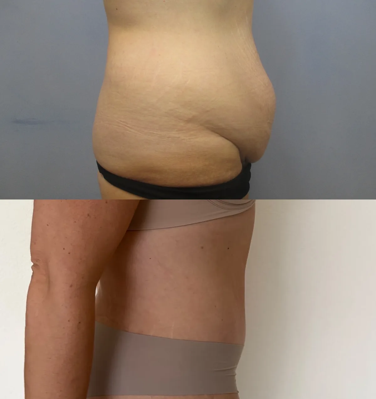 Tummy Tuck (Abdominoplasty) — before and after result by Dr. Jonathan Zaga