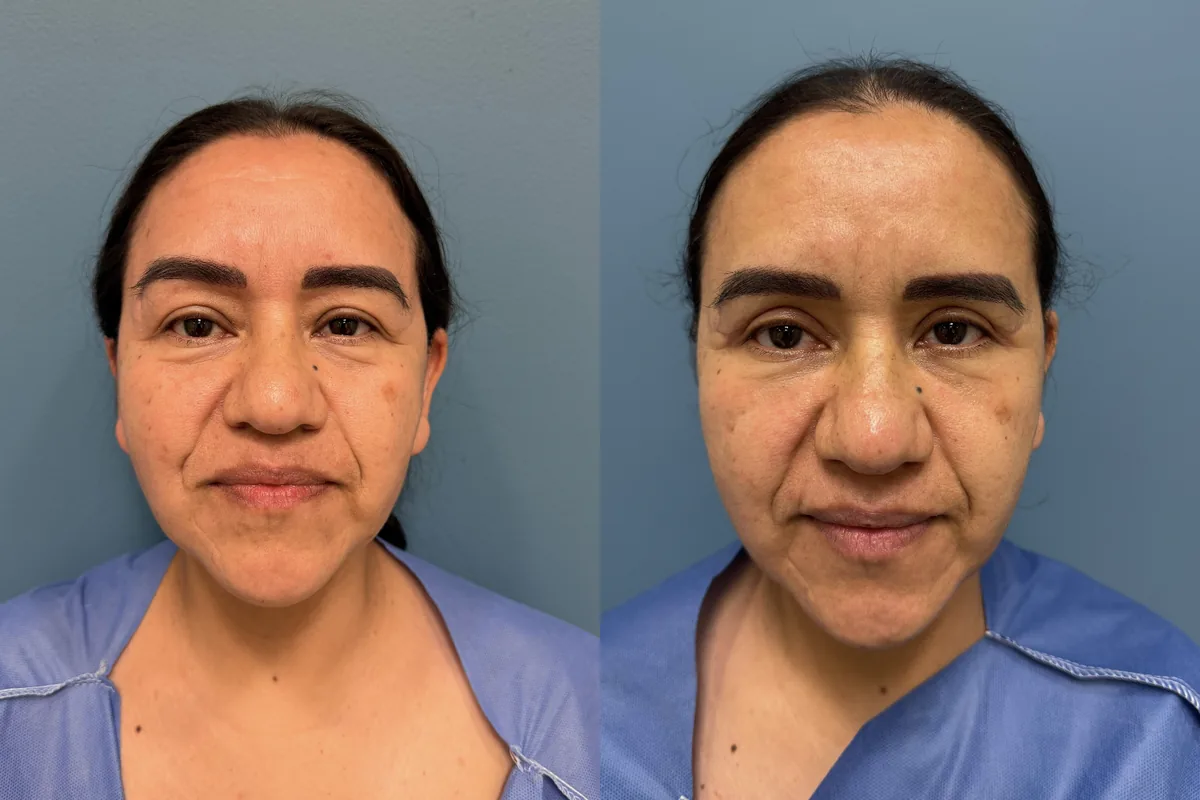 Eyelid Surgery (Blepharoplasty) — before and after result by Dr. Jonathan Zaga