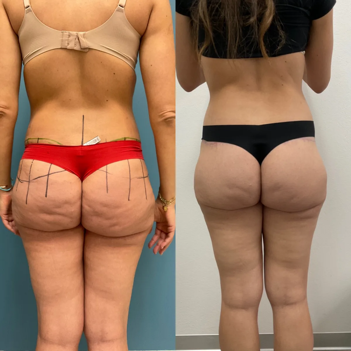 Buttock Lift — before and after result by Dr. Jonathan Zaga