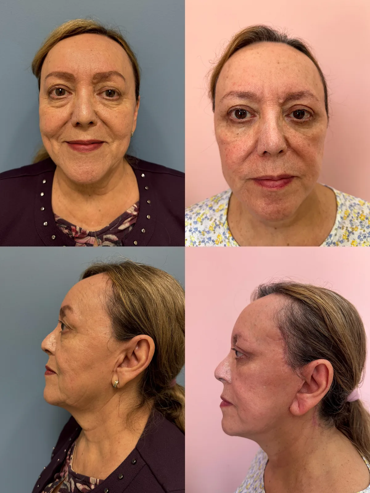 Facelift — before and after result by Dr. Jonathan Zaga