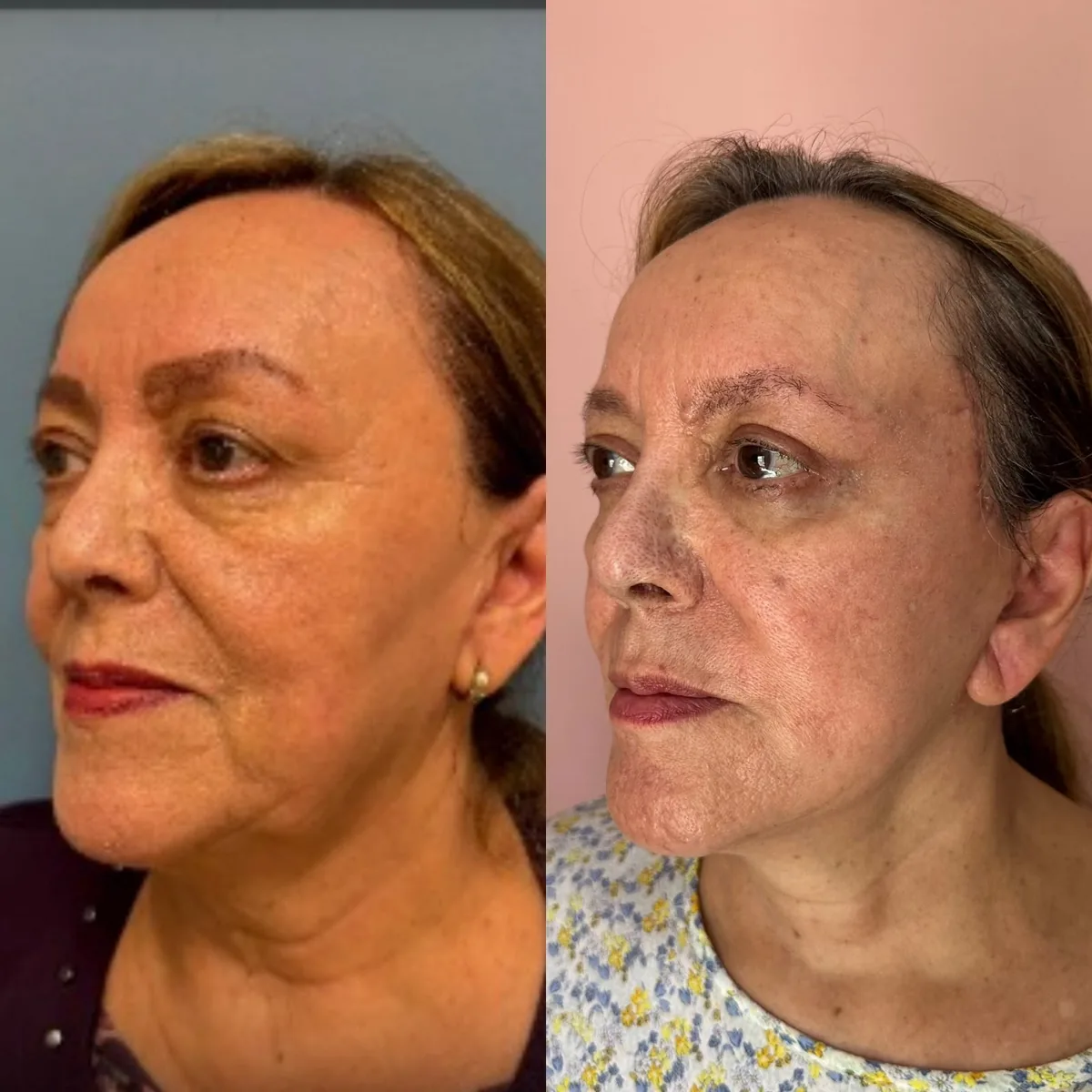 Facelift — before and after result by Dr. Jonathan Zaga