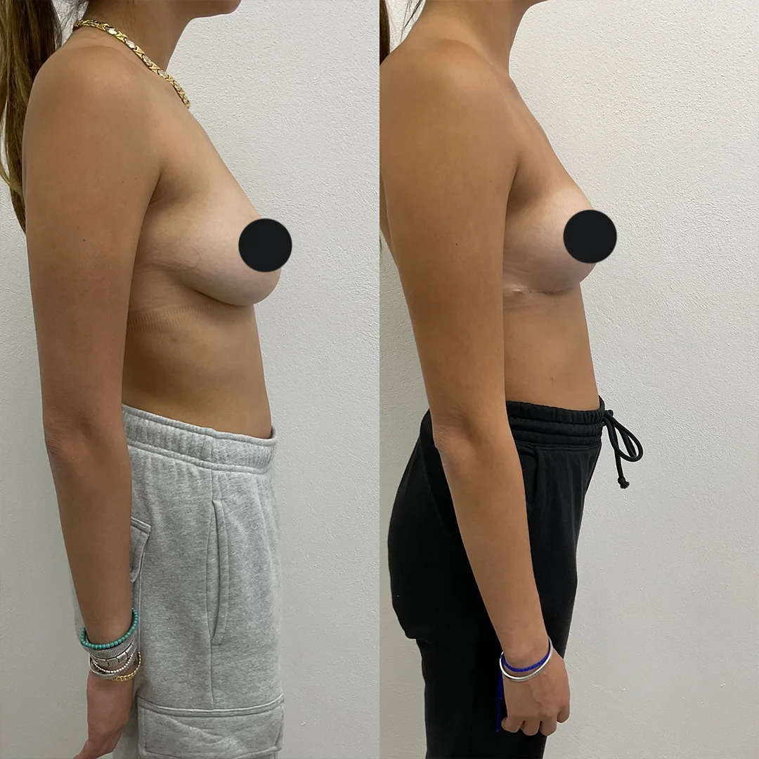 Breast Lift (Mastopexy) — before and after result by Dr. Jonathan Zaga