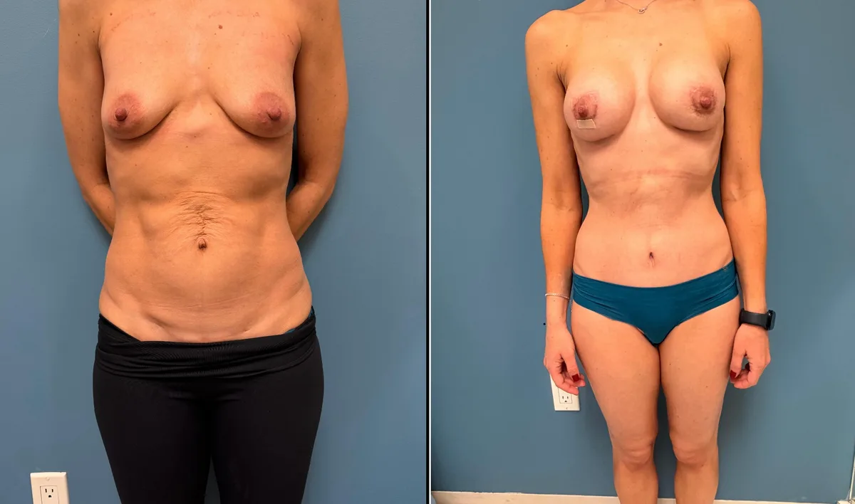 Breast Augmentation + Mini Tummy Tuck — before and after result by Dr. Jonathan Zaga