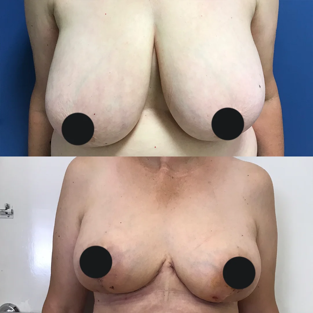 Breast Reduction with Lift — before and after result by Dr. Jonathan Zaga