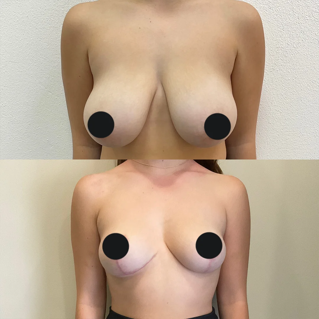 Breast Reduction with Lift — before and after result by Dr. Jonathan Zaga
