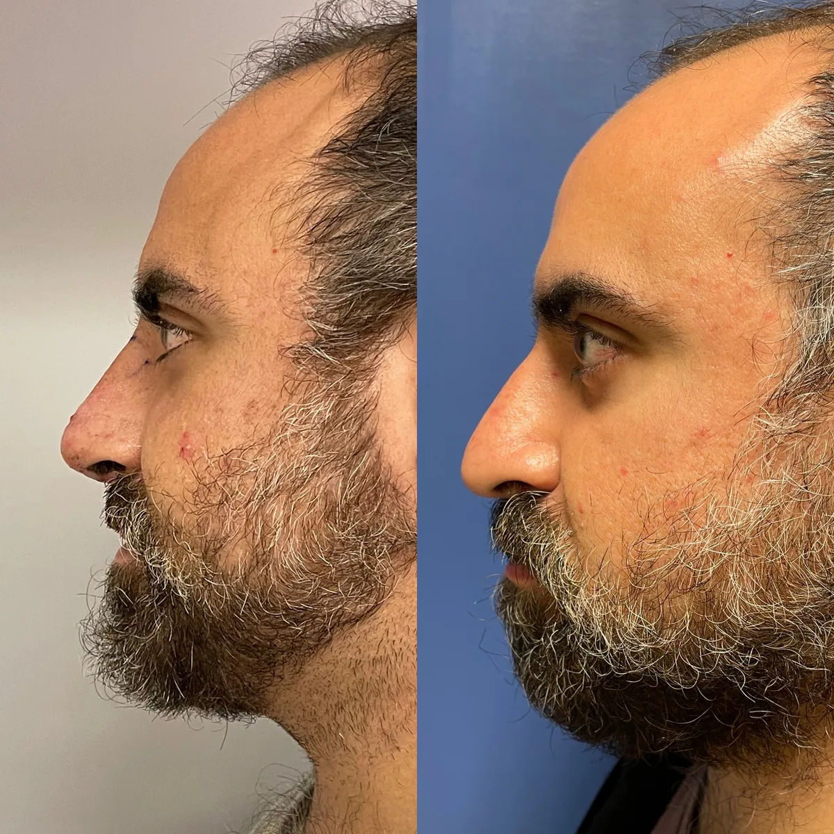 Rhinoplasty — before and after result by Dr. Jonathan Zaga